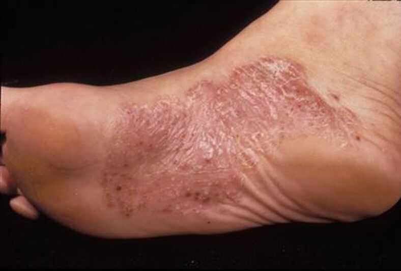 I sintomi della psoriasi sul piede