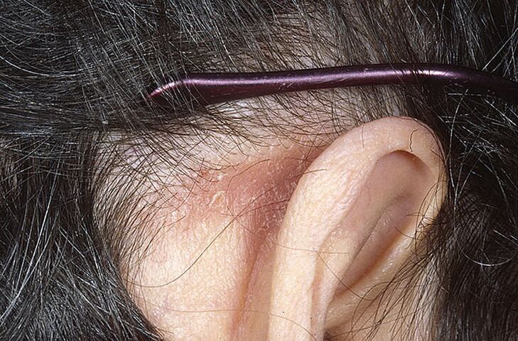 Placca di psoriasi dietro l'orecchio