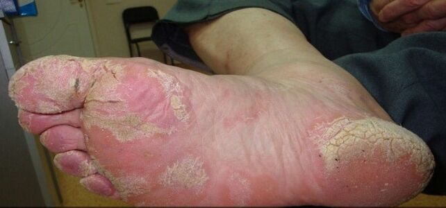 Psoriasi sui piedi