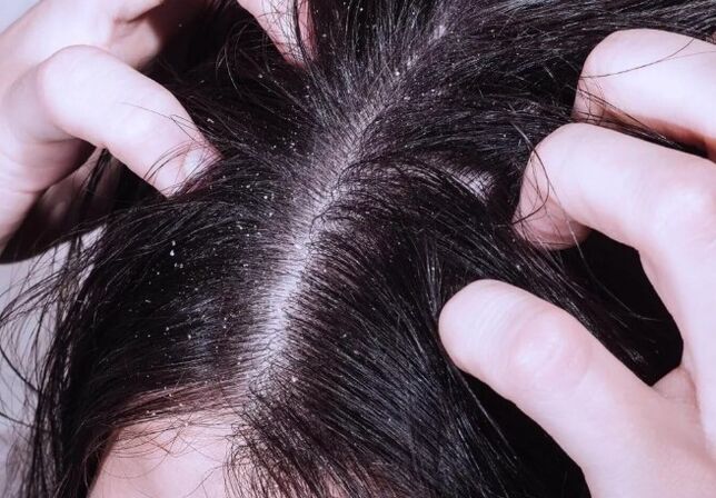 Psoriasi sulla testa