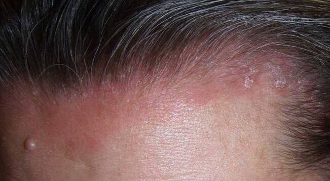 Cos'è la psoriasi