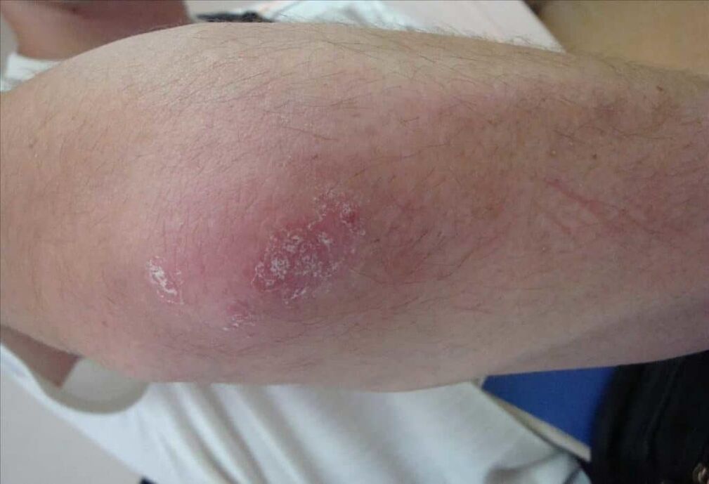 Che aspetto ha la psoriasi