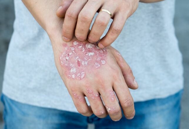 Psoriasi mesprichered