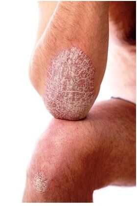 Psoriasi sull'Ellbogen