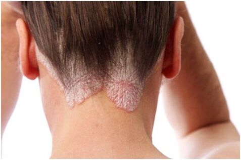 Psoriasi tra i capelli