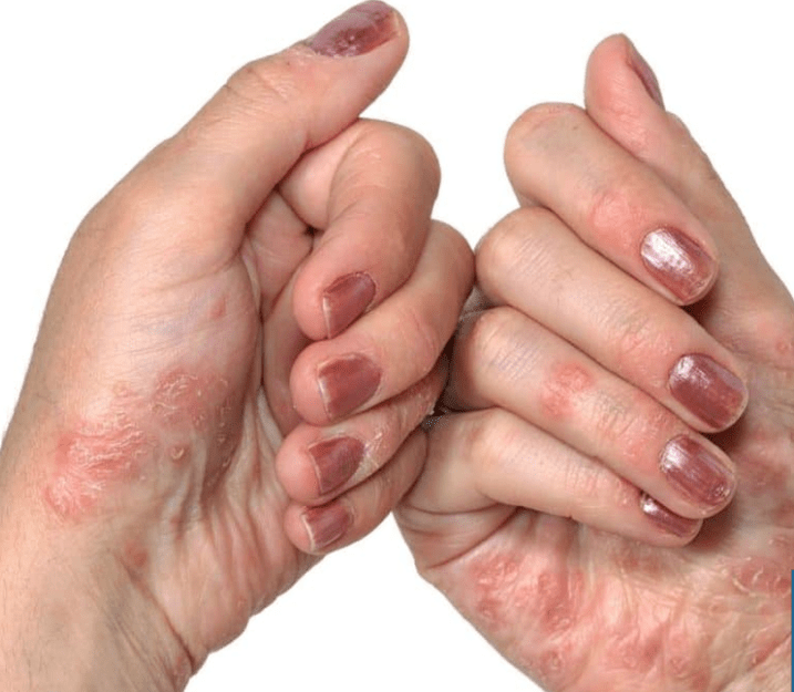 Psoriasi nelle mani