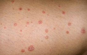 Placche di psoriasi