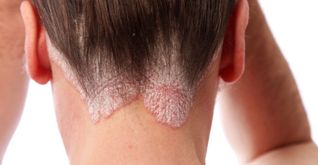 Psoriasi sulla testa della ragazza
