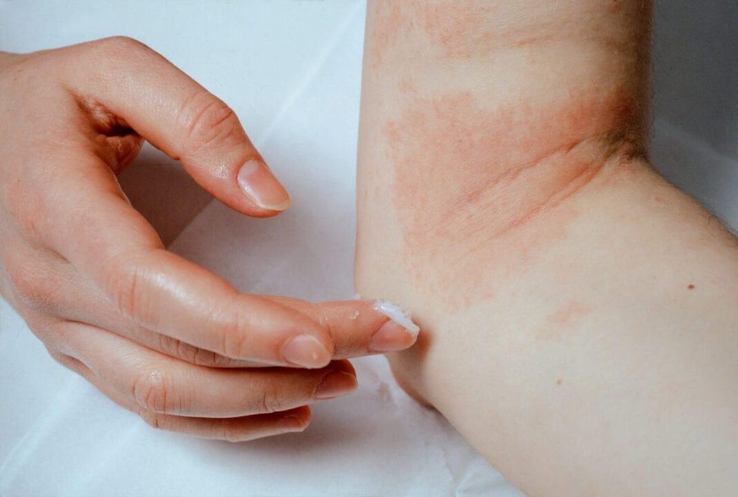 Trattamento della psoriasi