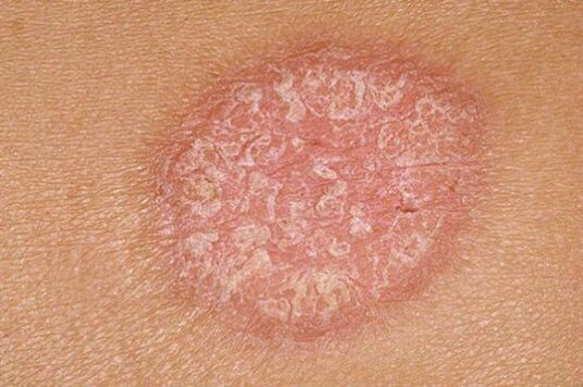 psoriasi