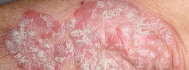 Psoriasi mesprichered