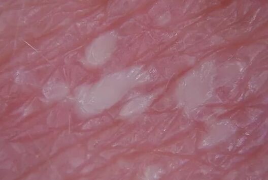 Pustuli psoriasi