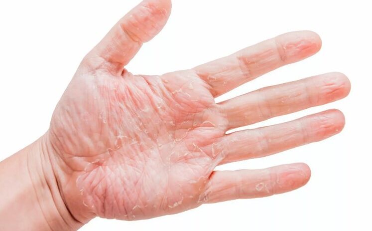 psoriasi