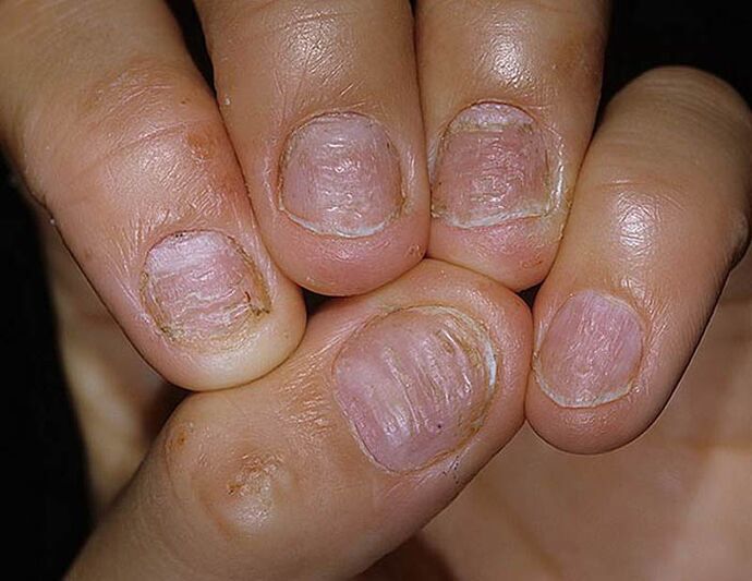 Psoriasi delle unghie