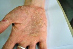 Psoriasi nel loro palmo