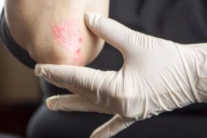 Psoriasi sull'Ellbogen