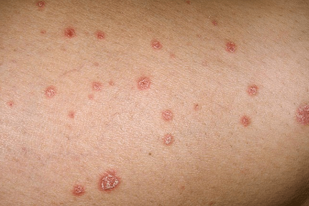 Placche di psoriasi