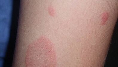 Come si manifesta lo stadio iniziale della psoriasi