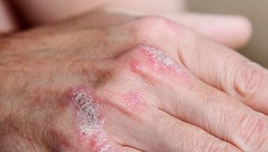 I sintomi della fase iniziale della psoriasi