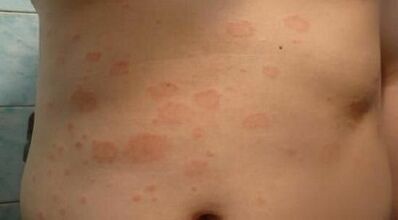 Come riconoscere le prime fasi della psoriasi