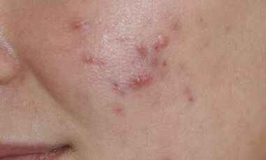 I sintomi della fase iniziale della psoriasi