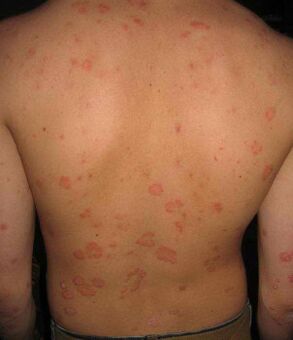 Psoriasi sulla schiena