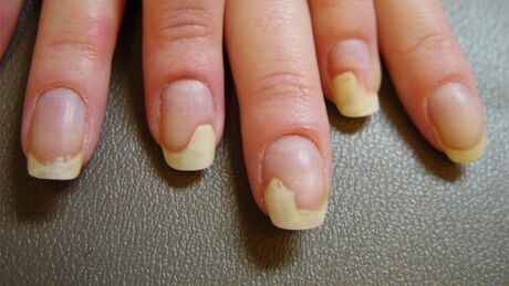 Macchie bianche sulle unghie dovute alla psoriasi