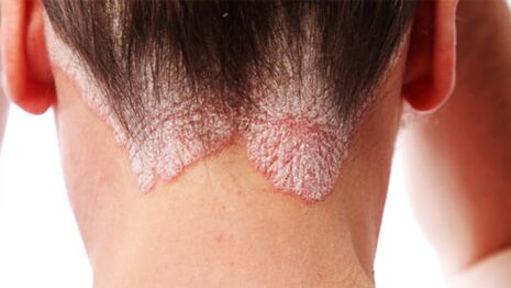 Placche di psoriasi sul cuoio capelluto