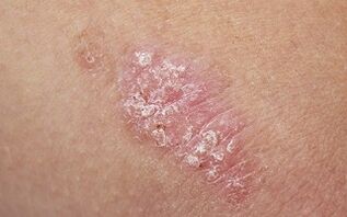 Cause della psoriasi