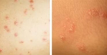 Principali sintomi della psoriasi