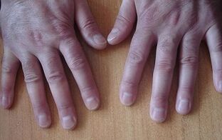 Sintomi della psoriasi nelle fasi iniziali