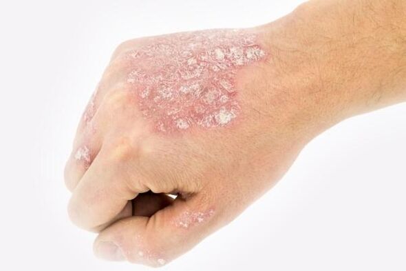 Meccanismo di sviluppo della psoriasi sulle mani