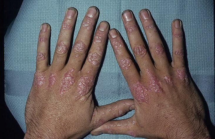 Ragioni per lo sviluppo della psoriasi sulle mani