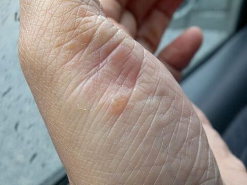 Foto della psoriasi sulla mano