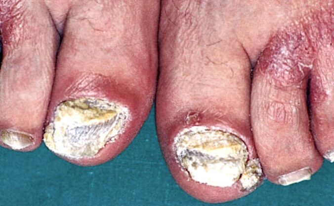 Grave ipercheratosi subungueale e placche psoriasiche sulle dita dei piedi