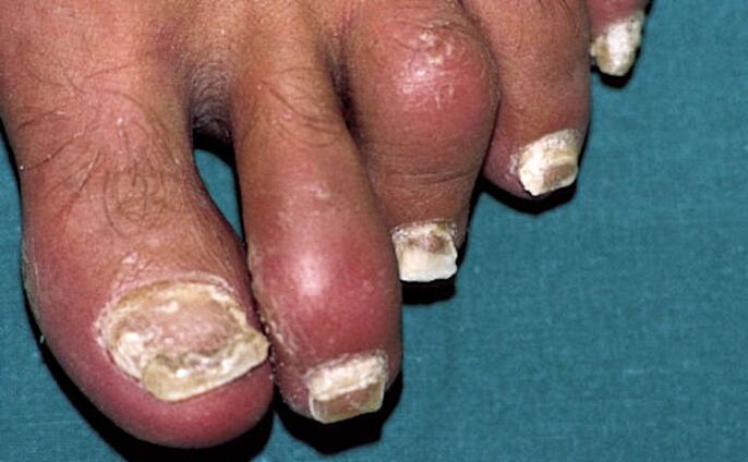 Psoriasi con coinvolgimento delle unghie e infiammazione delle articolazioni (artrite) delle dita dei piedi